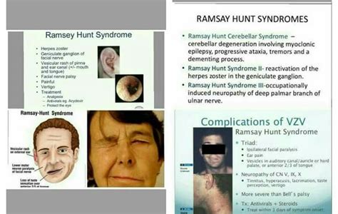 Ramsay Hunt Syndrome Newstempo