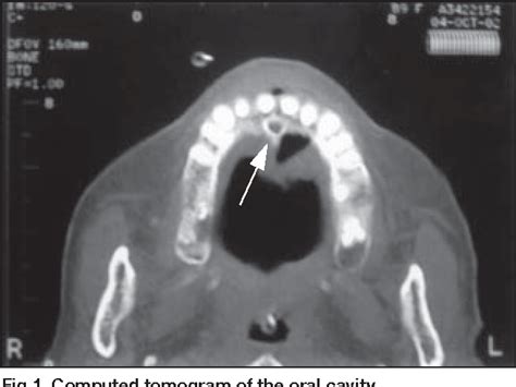 Figure 1 From A Case Of Oral Myiasis Due To Chrysomya Bezziana Semantic Scholar