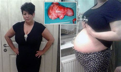 Mother Who Looked Pregnant For 3 Years Found To Have Tumour Growing