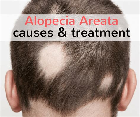 Alopecia Areata Treatment Dr Kumar Skin Hair And Cosmetic Clinic Bareilly
