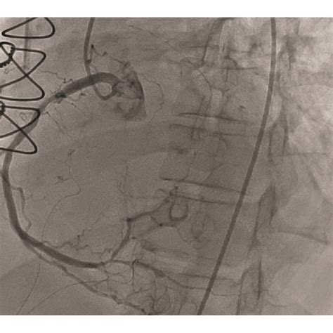 Left Heart Catheterization Showing Occlusion Of Svg Graft To Rpda