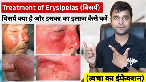 Erysipelas Treatment In Hindi विसर्प क्या है इसका इलाज कैसे करें