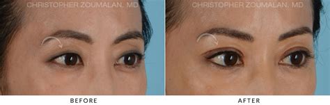 Asian Eyelid Double Eyelid Surgery Before And After Photo Gallery