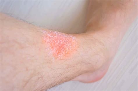 Stasis Dermatitis Venous Eczema Vein Clinic Perth