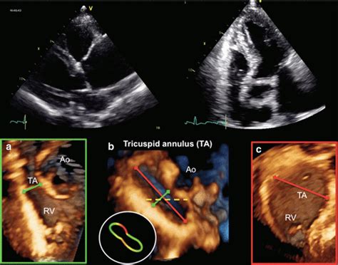 Tricuspid Annulus Measurements Dynamic Changes In Health And Disease