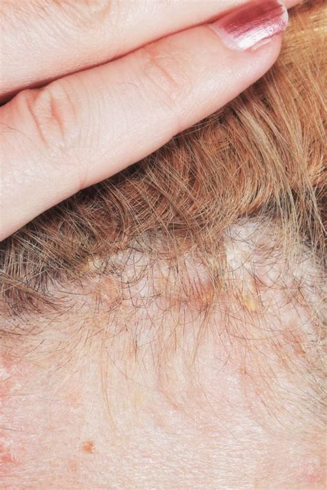 How To Cure Scalp Psoriasis Permanently