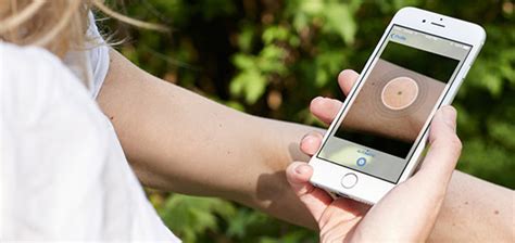 Worried About A Spot This App Can Help You Detect Skin Cancer