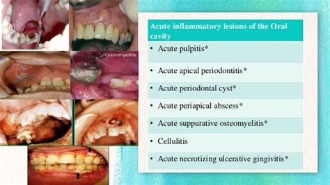 Inflammation In The Oral Cavity