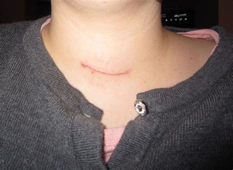 Parathyroidectomy Scar 11 Days Post Operation Exousiavampira Flickr