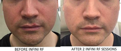 Genius Rf Microneedling Before And After Photos Patient 20 Washington Dc Mi Skin Dermatology