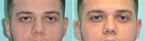 Tear Trough Under Eye Injections Before And After Photos The Naderi