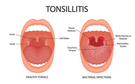 White Spots On Tonsils Symptoms Causes And Treatment Health Healer