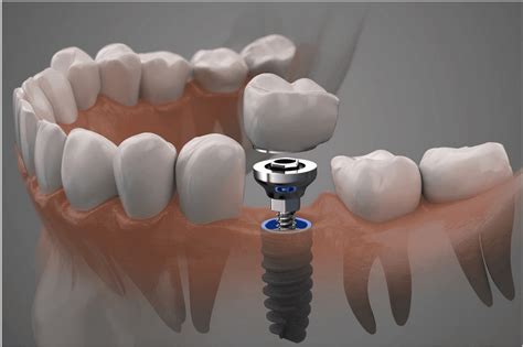What Are The Dental Implant Procedure Steps 2023 Dents And Implants