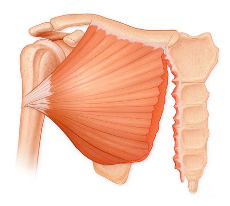 Pectoralis Muscle Tear Photograph By Medical Imagery Studiosdesign