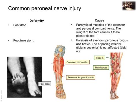 Common Peroneal Nerve Lesion Symptoms Cloudshareinfo