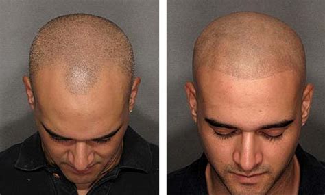 Kelowna Area Scalp Micro Pigmentation Removal