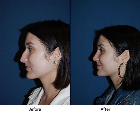 Best Nose Job Surgeon In Charlotte Nc For The Best Experience