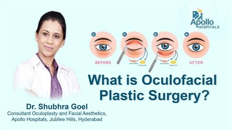 What Is Oculofacial Plastic Surgery Dr Shubhra Goel Consultant
