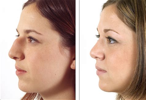 Rhinoplasty Before And After Hump Removal