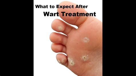Plantar Warts Home Care Youtube