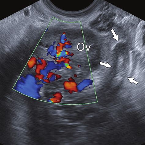 Right Lower Quadrant Pain Appendicitis Ovulation Symptoms