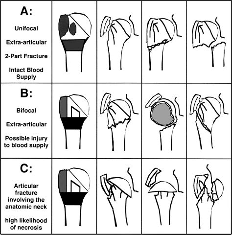 Neer Classification Of Proximal Humerus Fractures Porn Sex Picture