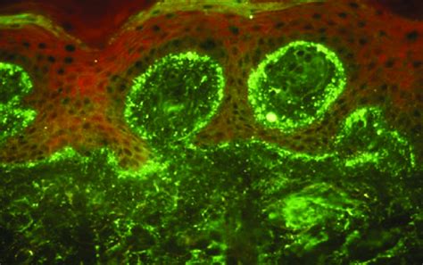 Dermatitis Herpetiformis Histology