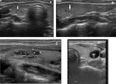 Thyroid Ultrasonic Findings Characteristic For Children A Ectopic