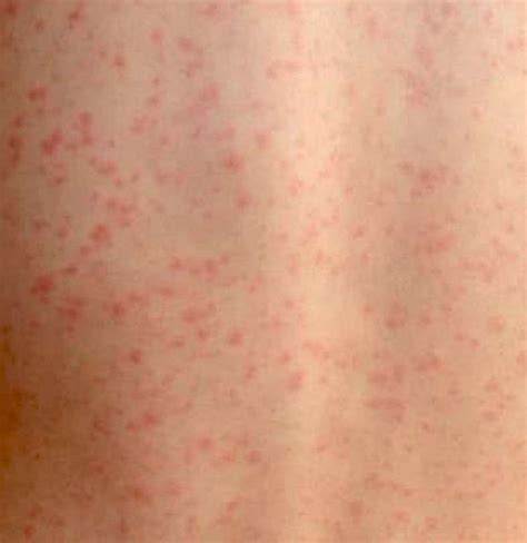 Scarlet Fever Causes Symptoms Treatment And Complications