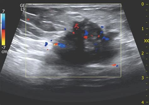 Reliable Clinical And Sonographic Findings In The Diagnosis Of Abdominal Wall Endometriosis Near