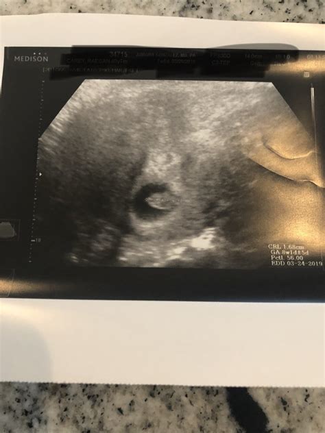 Post Your Ultrasounds Here Page 3 — The Bump