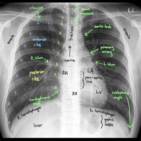 Reading Chest X Rays Anatomy Labelled Reading A Grepmed