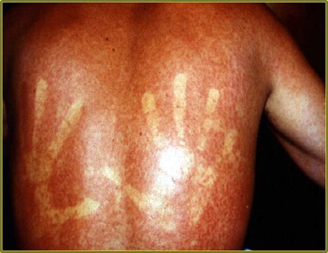 A characteristic itchy rash (small red spots, called petechiae) appears along with the fever and spreads from the extremities to cover the entire body except for the. zika virus rash - pictures, photos