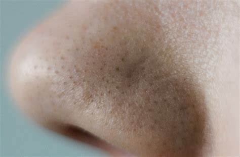 Glycolic Acid Clogged Pores Guide For Unclogging Pores