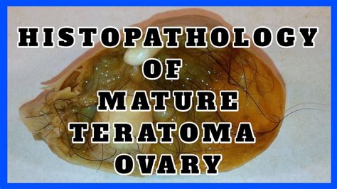 Histopathology Of Mature Teratoma Ovary Pathtube Youtube