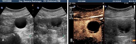 Bosniak 2f Cyst A Grey Scale Sonography Shows In The Mid Portion Of