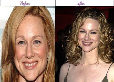did laura linney undergo plastic surgery including boob job nose job botox and lips famous