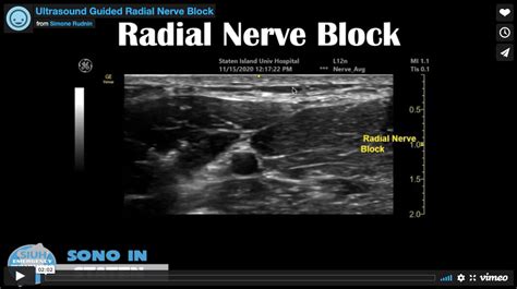 Ultrasound Guided Radial Nerve Block — Siuh Emergency Residency Program