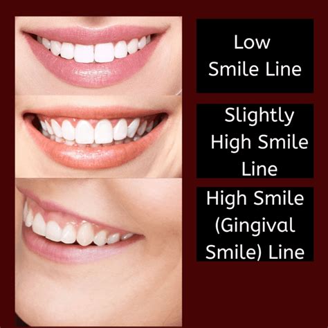 What Is The Gingival Smile Line West Palm Beach Dentist