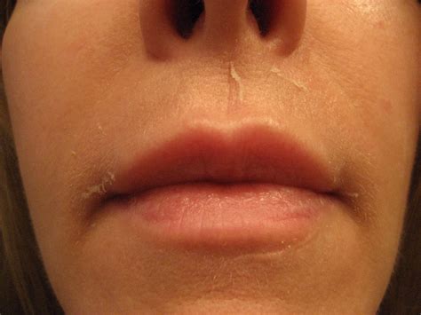 Chemical Peels For Acne And Anti Aging Above Lip Vertical Lines The