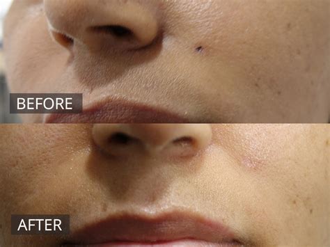 Laser Mole Removal Melbourne The Doc Cosmetic And Laser Clinic