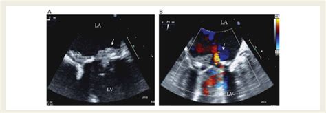 Mitral Prosthetic Valve Endocarditis With Prosthetic Obstruction