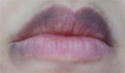 I Have Dark Spots Around My Lips I Fear That A Topical Cream Like