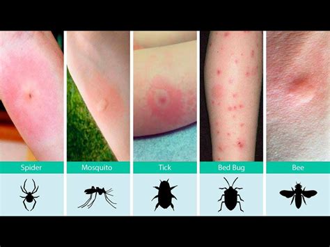 Mosquito Bites Vs Bed Bug Bites Larablog