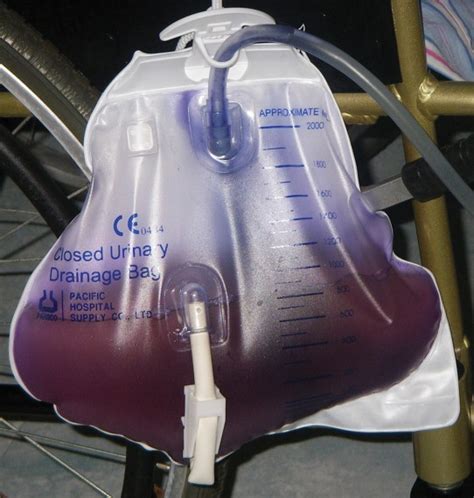 However, if left untreated, purple urine bag. Purple Urine Bag Syndrome | Medical Laboratories