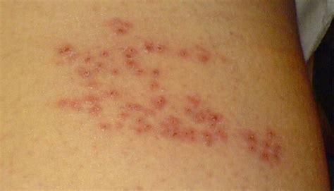 Shingles Symptoms And What You Need To Know Shingling Signs Of