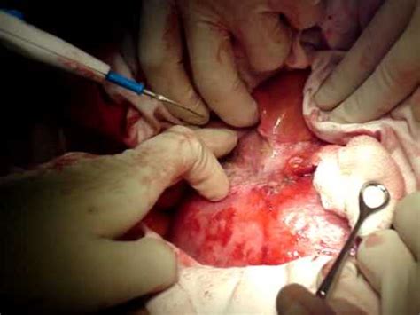 O aneurisma cerebral é uma dilatação anormal de uma das artérias cerebrais. ABDOMINAL AORTIC ANEURYSM / OPEN REPAIR (1) - YouTube