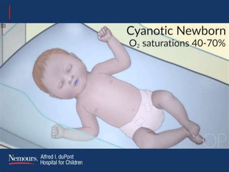 56 Best Of How Is Cyanosis Treated In Newborns Insectpedia