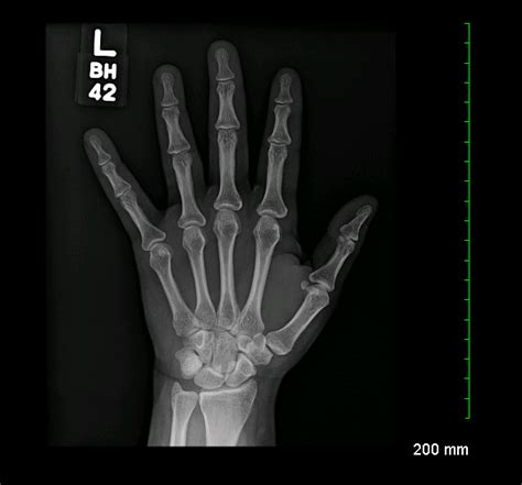 Archive Of Unremarkable Radiological Studies Left Hand X Ray Stepwards