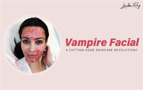 The Vampire Facial: A Cutting-Edge Skincare Revolution? – London Rag India